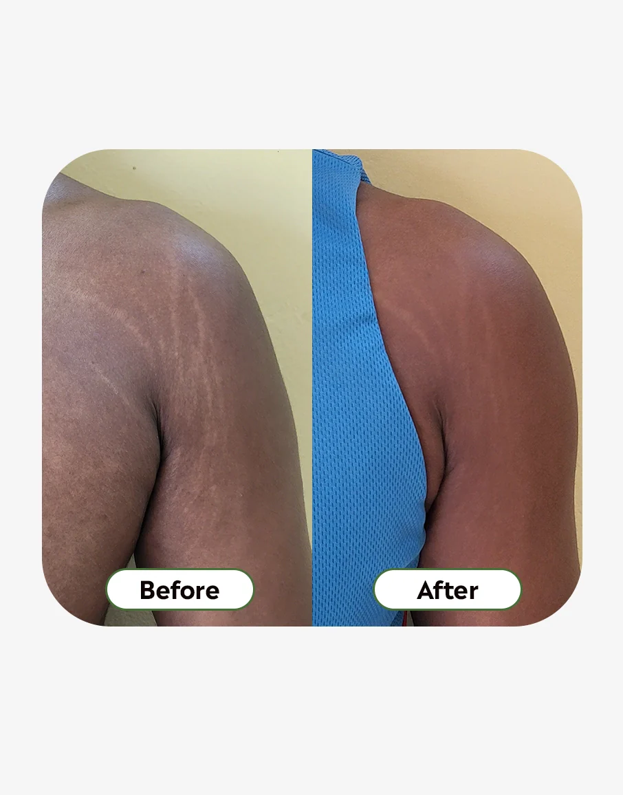 Stretch Marks Cream - Image 3